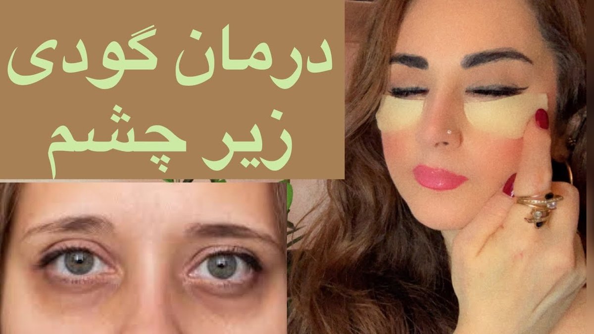 علت اصلی سیاهی و گودی زیر چشم + بهترین درمان‌های کلینیکی موثر در ۱۴۰۳
