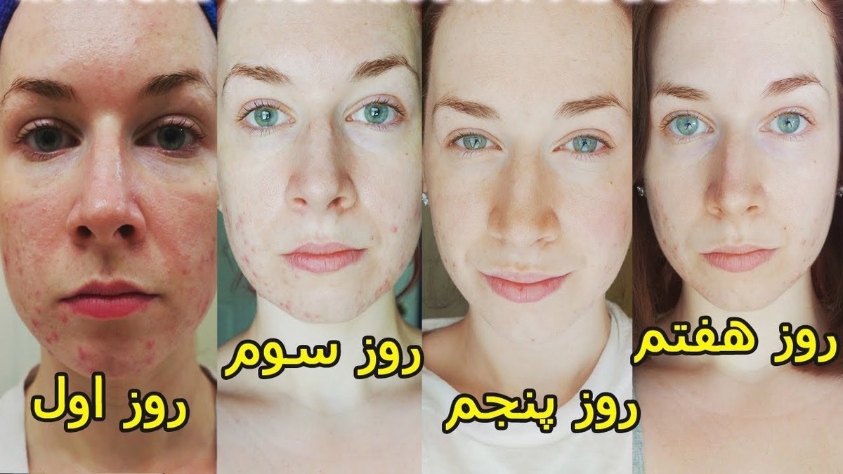 ۱۰ روش خانگی ایمن و مؤثر برای سفید کردن دندان‌ها بدون آسیب به مینا