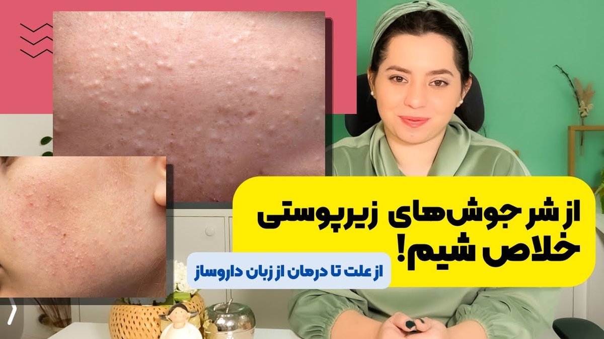بهترین روتین پوستی برای درمان جوش‌های زیرپوستی و جای لک: راهنمای جامع ۲۰۲۴